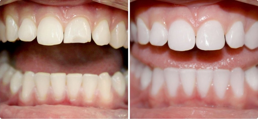 В каких случаях нужна реставрация зубов композитным материалом