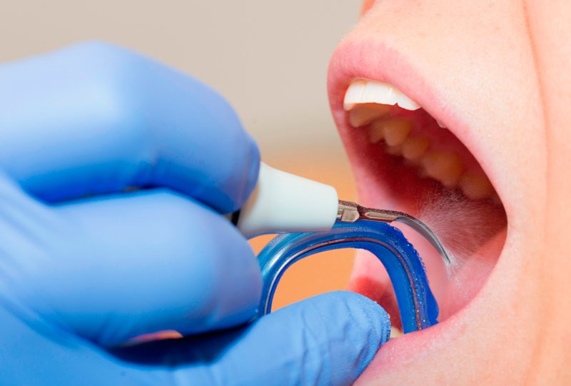 Как проводится процедура чистки зубных камней ультразвуком