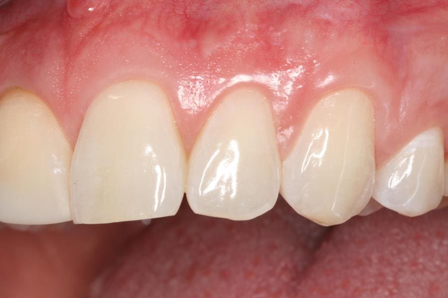 Виды реставрации коронковой части зуба