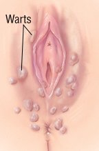 Кондиломы наружных половых органов