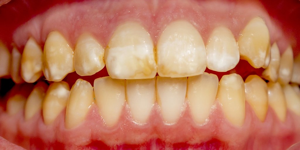 Некариозные поражения твёрдых тканей зуба