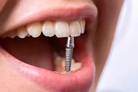 Применение титановых штифтов в стоматологии