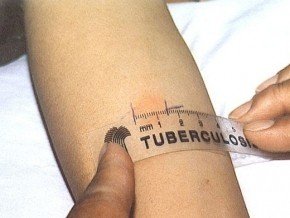 Туберкулин