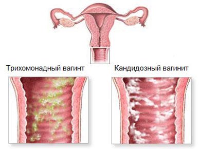 трихомонадный вагинит