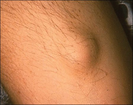 Узелки на коже - симптомы какой болезни — Клиника «Доктор рядом»