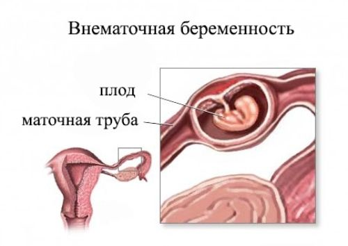 Лечение воспаления яичников у женщин | Симптомы и лечение воспаления женских яичников в Ижевске